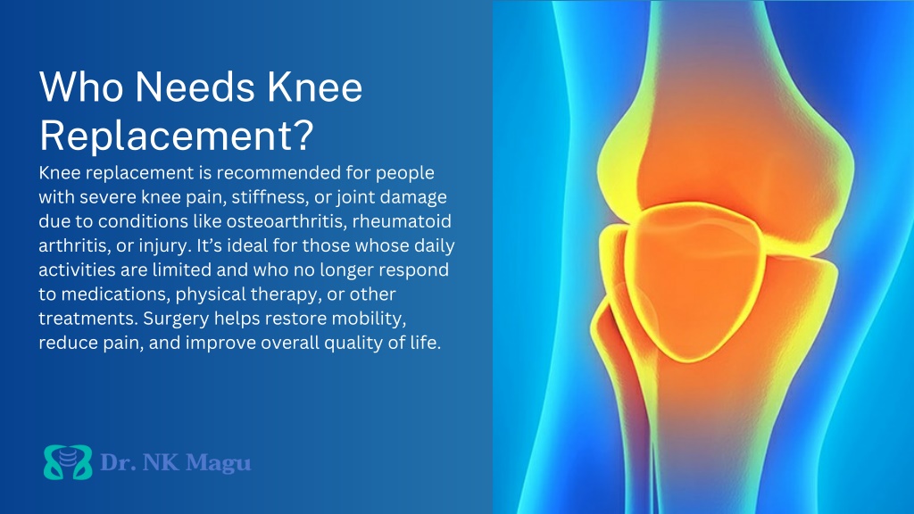 PPT - Knee Replacement Surgery Dr N.k magu PowerPoint Presentation ...