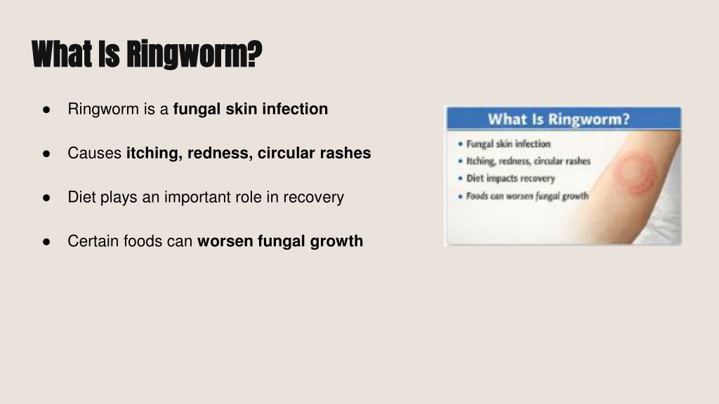 PPT - Ringworm Diet: Foods to Eat & Avoid for Ringworm Infection ...