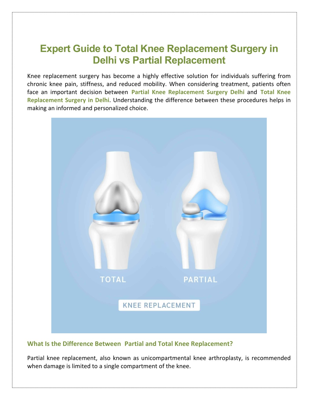 PPT - Expert Guide to Total Knee Replacement Surgery in Delhi vs ...