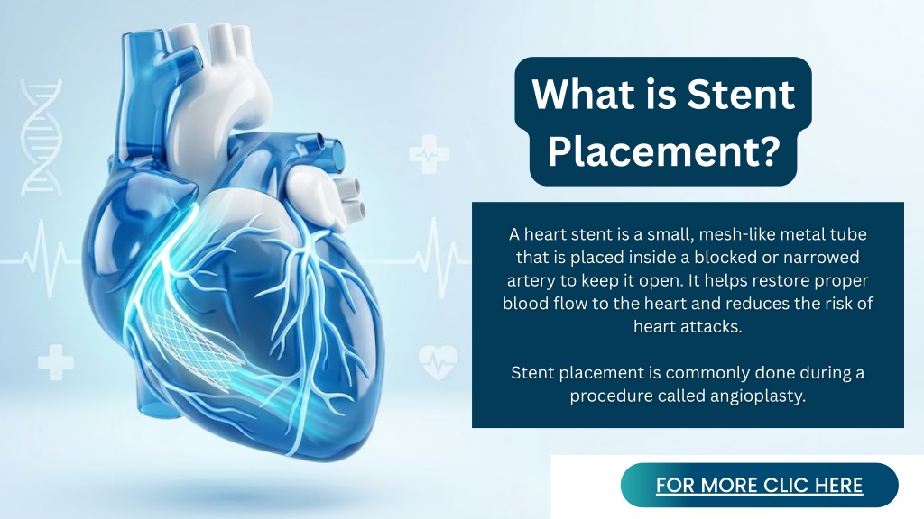 PPT - Heart Stent (Angioplasty): Procedure, Recovery & Diet | Cardiac ...